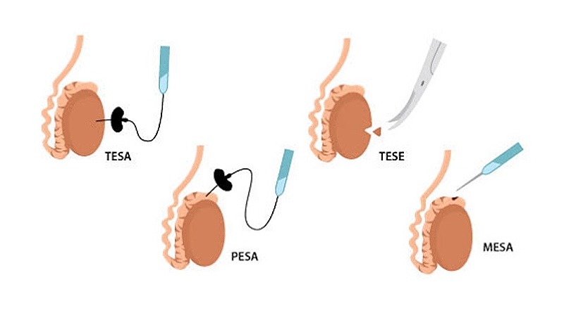 Tesa / Tese / Pesa / Mesa surgery difference