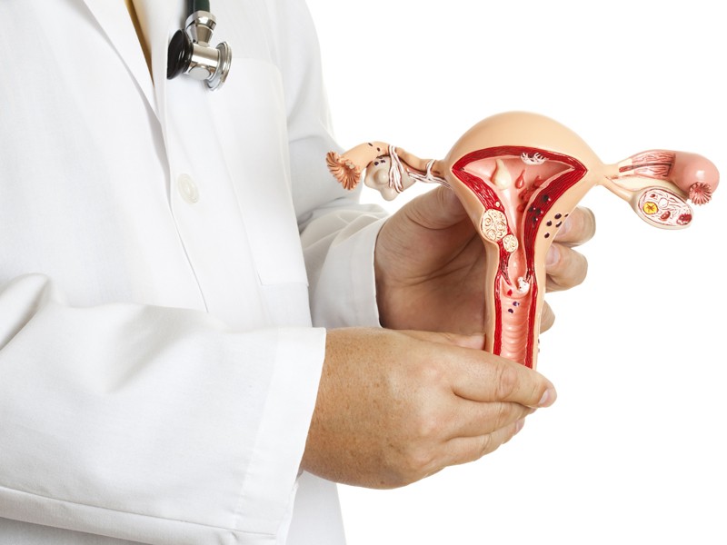 Adenomiosis uterina.
