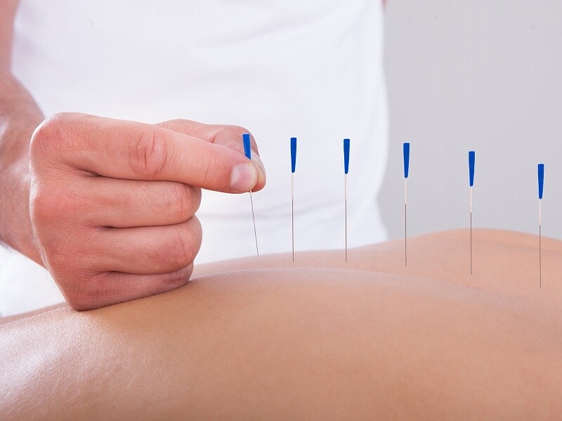 Acupuncture in assisted reproductive technologies